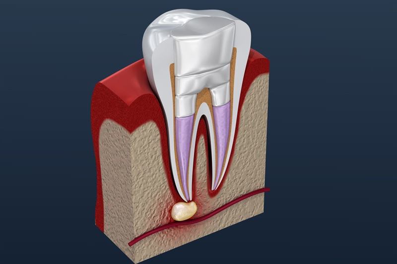 Can an infected tooth be extracted?